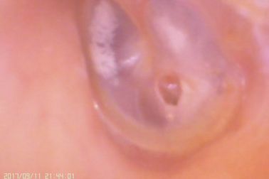 고막 막의 기공을 위한 영상 귀와 코 C amera 디지털 방식으로 이경