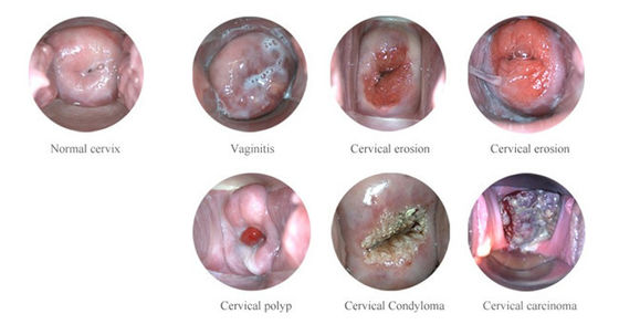 휴대용 디지털 전자 콜포스코프