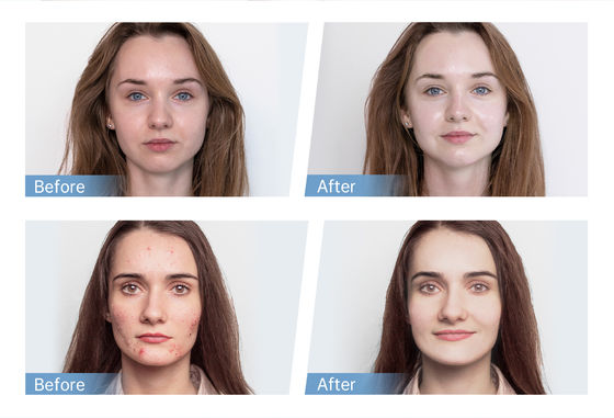 최신 4극 EMS 자동 혈청 어플리케이터 하이드라 펜 H5 페이스 스킨 더마 마이크로니들링 펜 에센스 콜라겐 재생