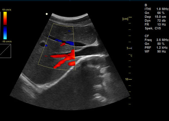 15 인치 가득 차있는 디지털 방식으로 색깔 도풀러 기계 2 usb 포트를 가진 휴대용 도풀러 화상 진찰 초음파